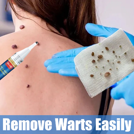 Warts Remover Original Mole Remover Skin Tag Removal Pen Without Leaving Scars