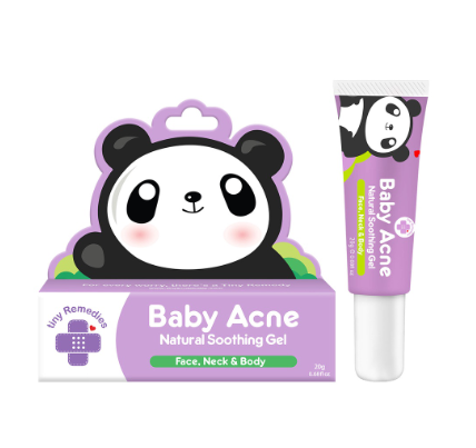 Tiny Buds Baby Acne Soothing Gel 20g